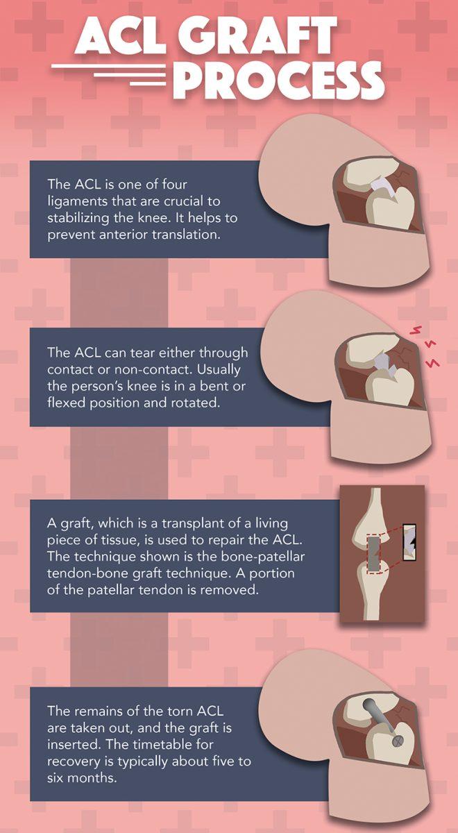 ACL Graft Process